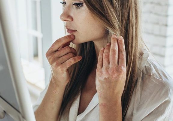 Is Eczema An Autoimmune Disease