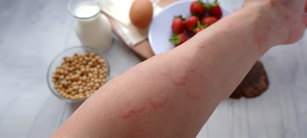 Spongiotic Dermatitis Foods to Avoid