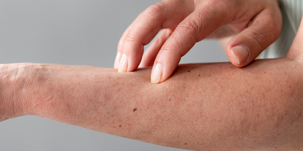 Asteatotic Eczema and Xerotic Eczema