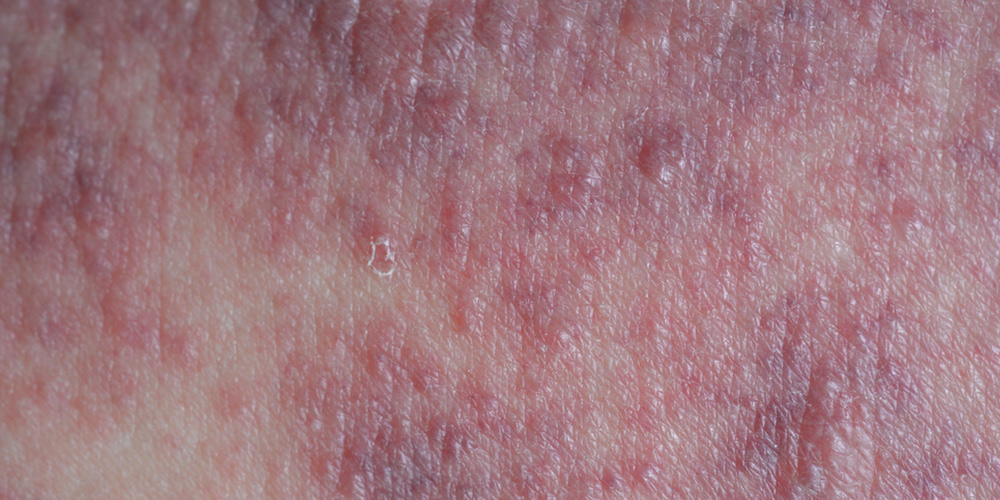 Asteatotic Eczema Symptoms Causes And Treatment