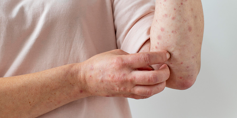 Presentation Of Asteatotic And Xerotic Eczema