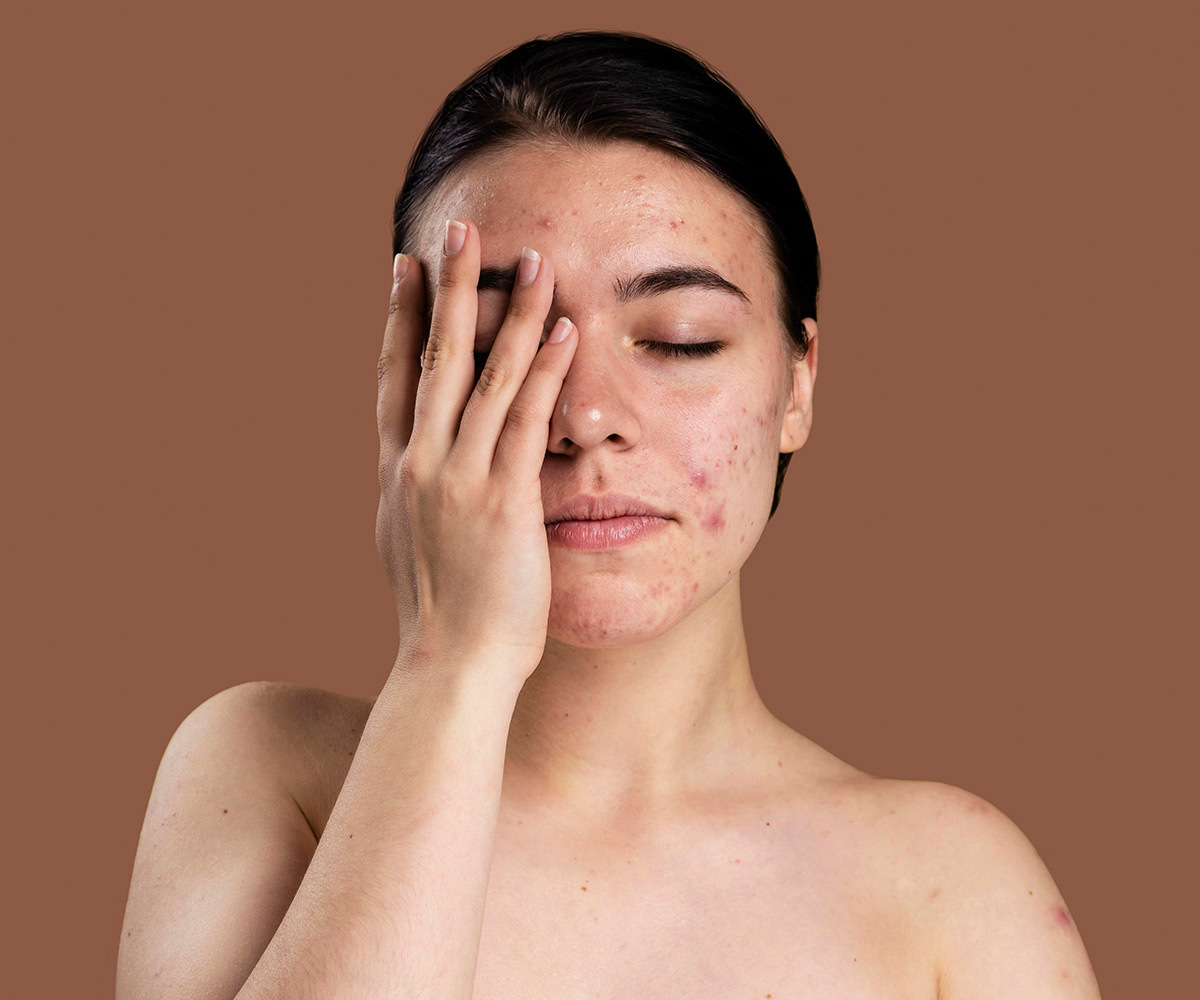 Girl Facing Acne Conglobata