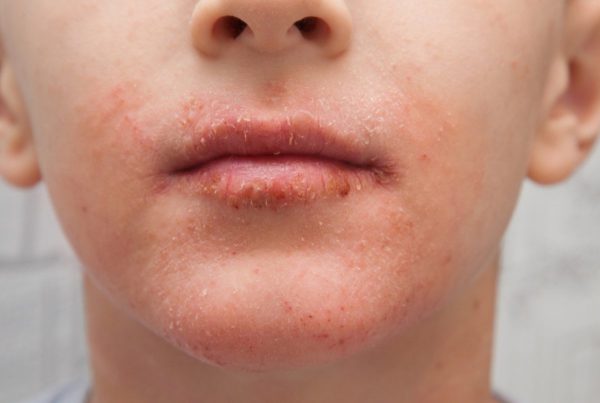 Lip Licker Dermatitis