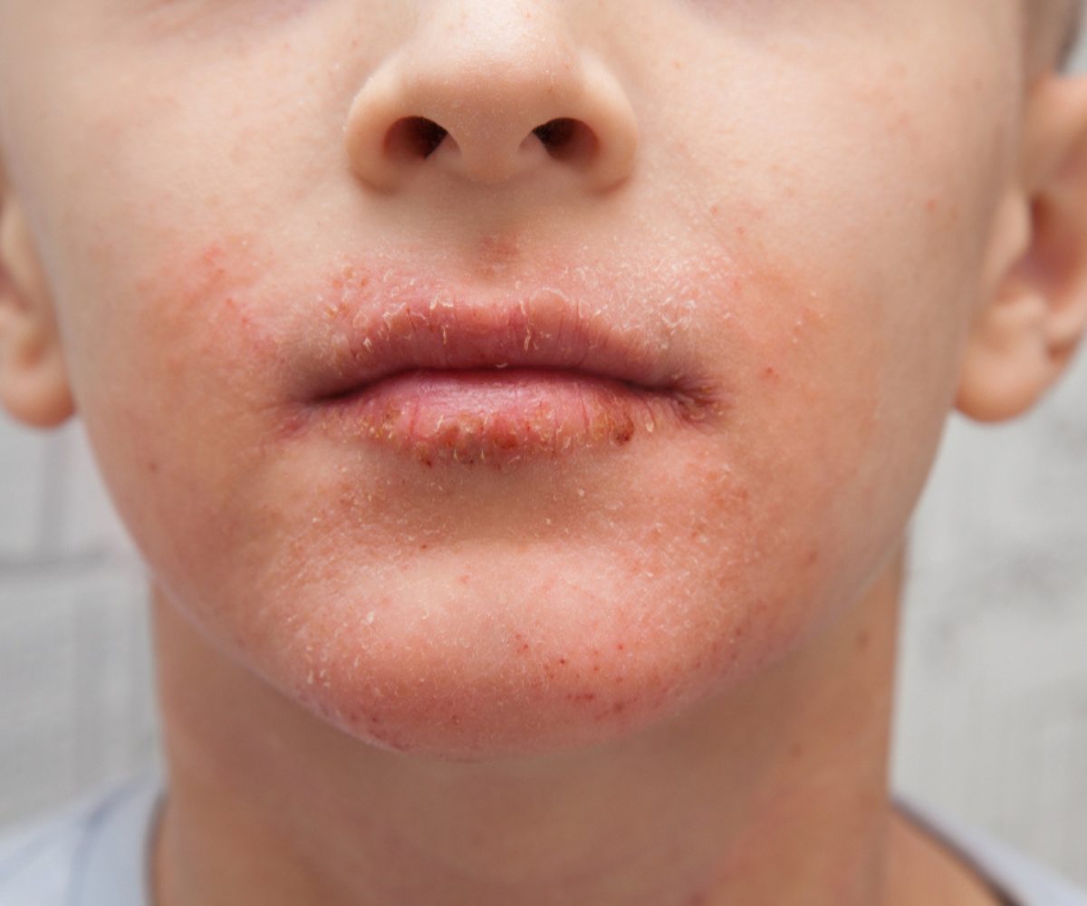 Lip Licker Dermatitis