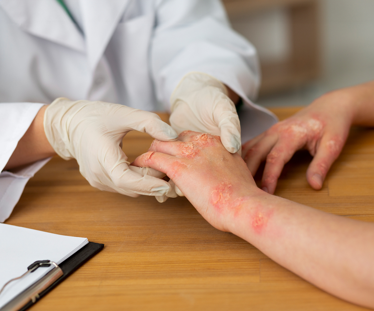 Nummular Eczema: Signs, Treatment, and More