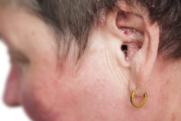Psoriasis In Ear