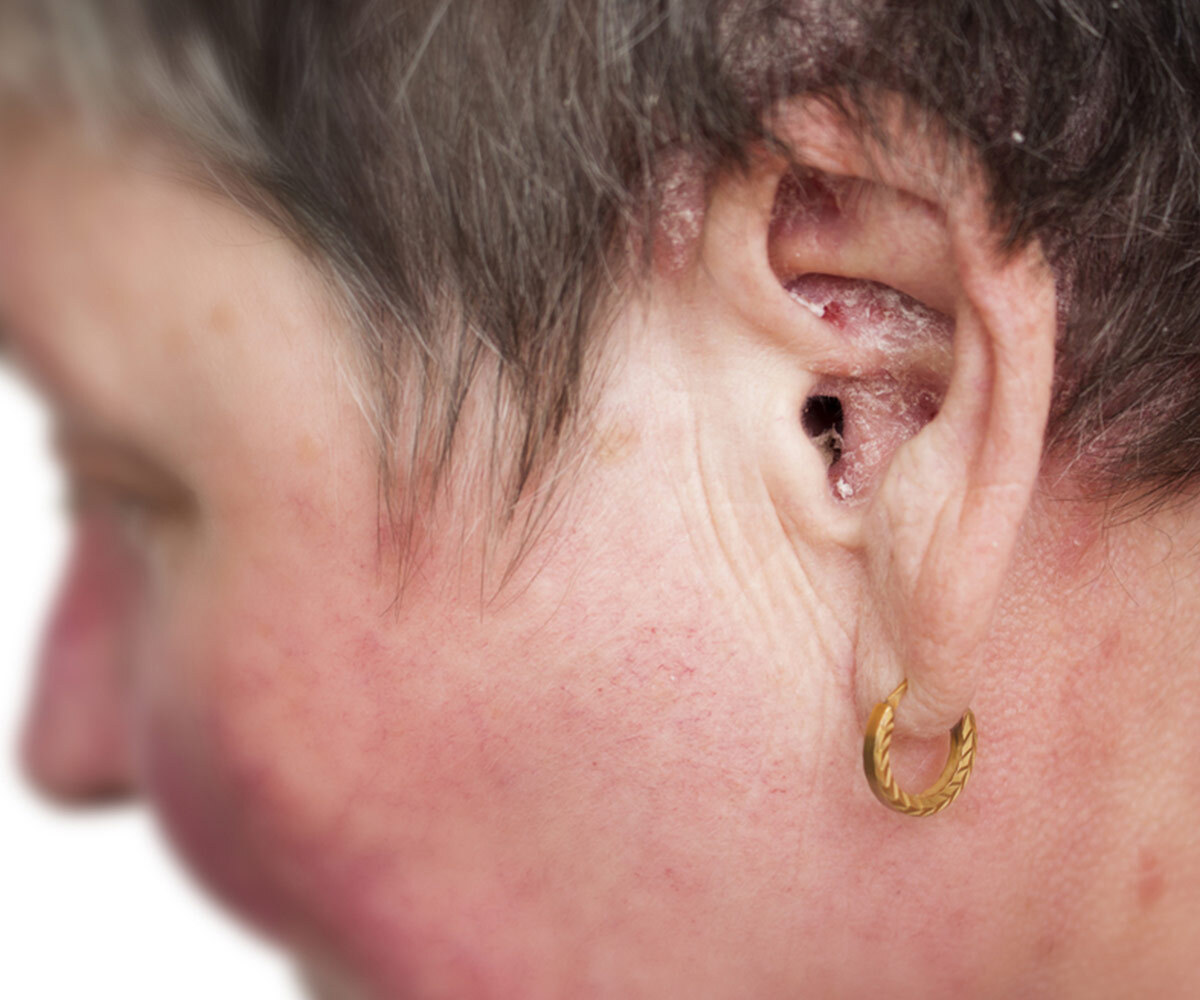 Psoriasis In Ear
