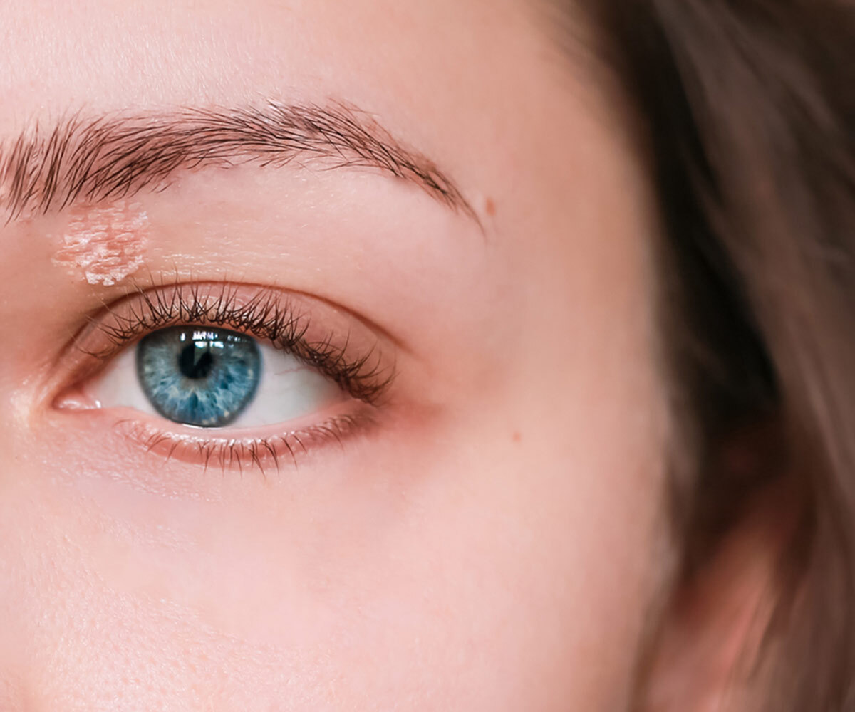 eyelid-psoriasis