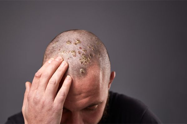 Scalp Eczema