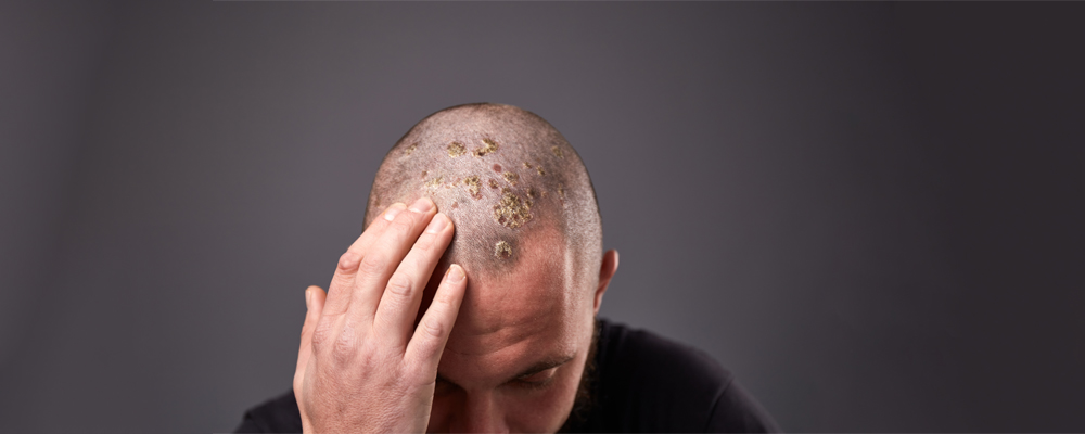 Scalp Eczema