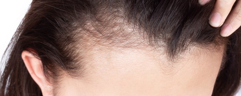 female-holding-frontal-hairs-showing-her-frontal-fibrosing-alopecia