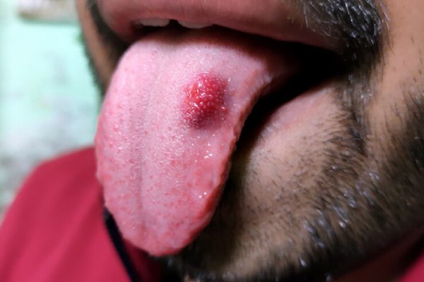 warts-on-tongue