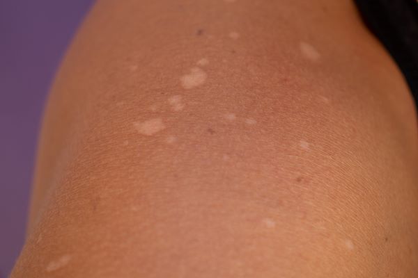 white-sun-spots-on-shoulder