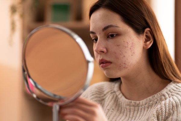 patient dealing with acne fulminans