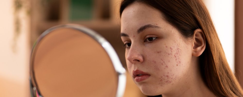 person dealing with acne fulminans