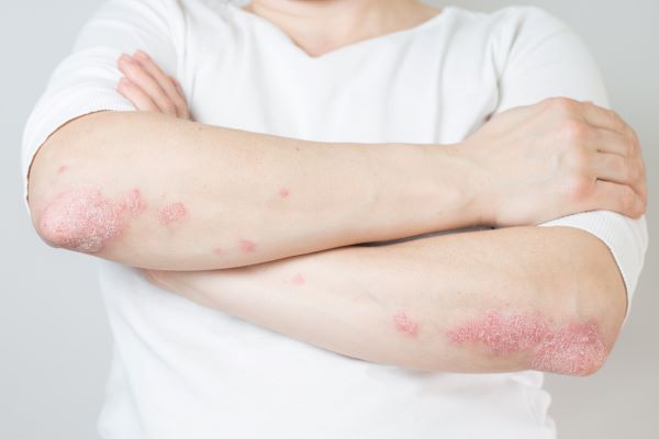 psoriasis on elbow