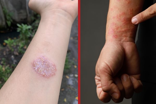 ringworm and eczema