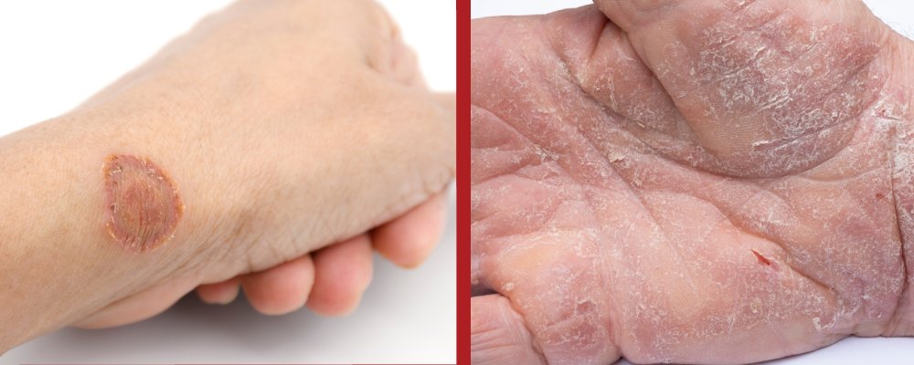 ringworm vs eczema