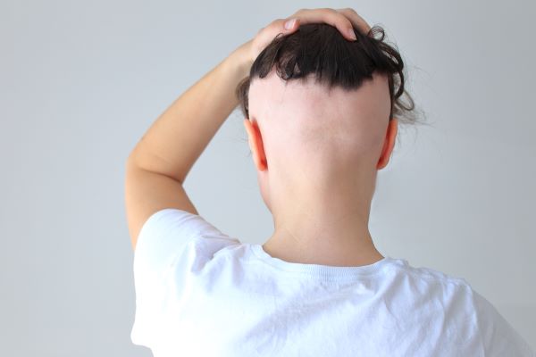 bald patches of retrograde alopecia