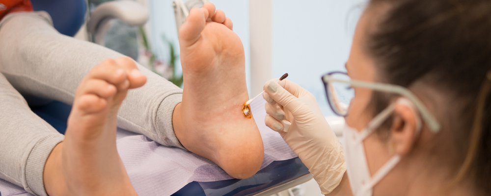 doctor treating plantar warts