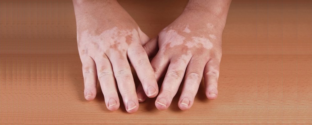 genetics of vitiligo