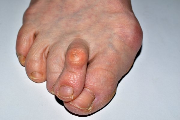 psoriatic arthritis in feet