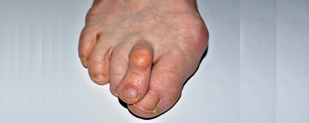 signs of psoriatic arthritis in feet