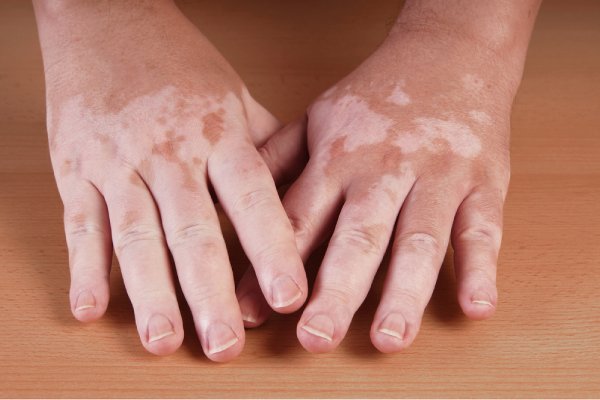 vitiligo a genetic disorder