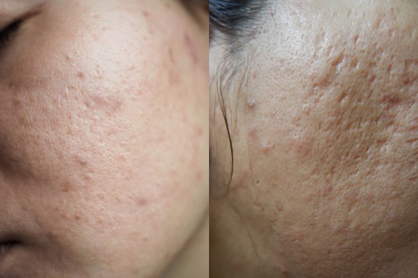 acne scars vs acne marks