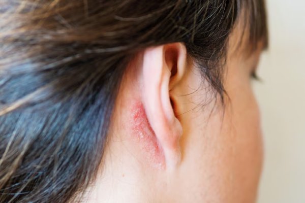 eczema behind ear