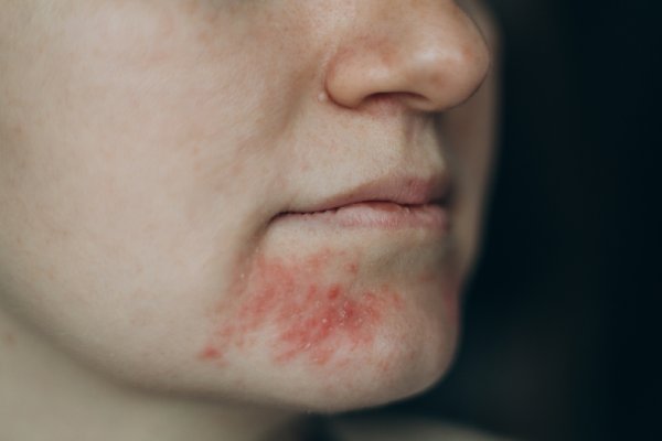 eczema herpeticum on face