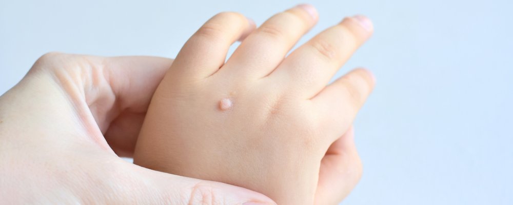 kids warts on child hand