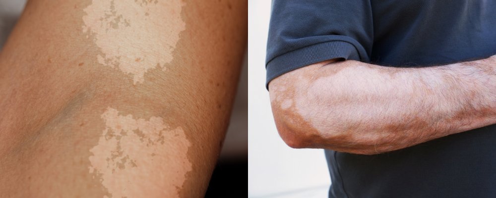 tinea versicolor vs vitiligo