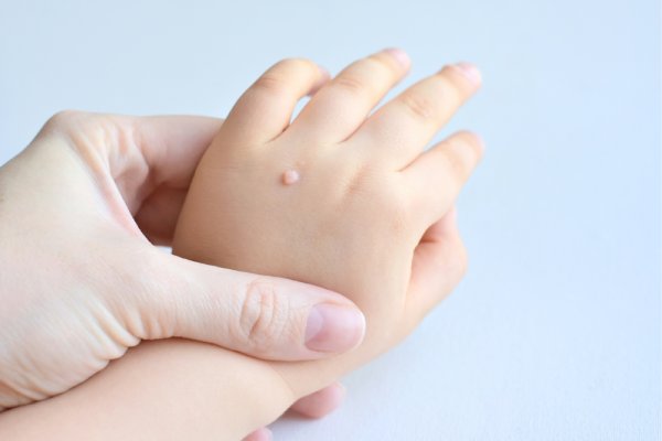 warts on kids hand