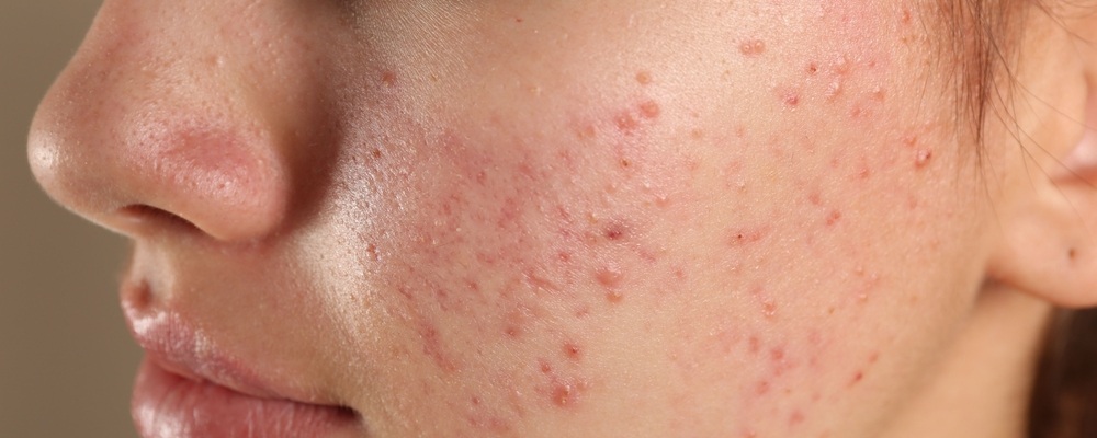 acne-on-woman-face