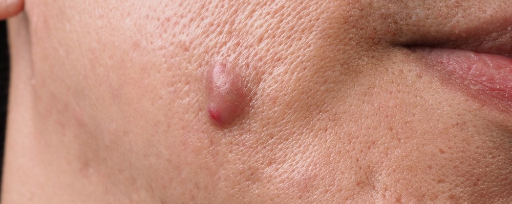 hidradenitis-suppurativa-on-face