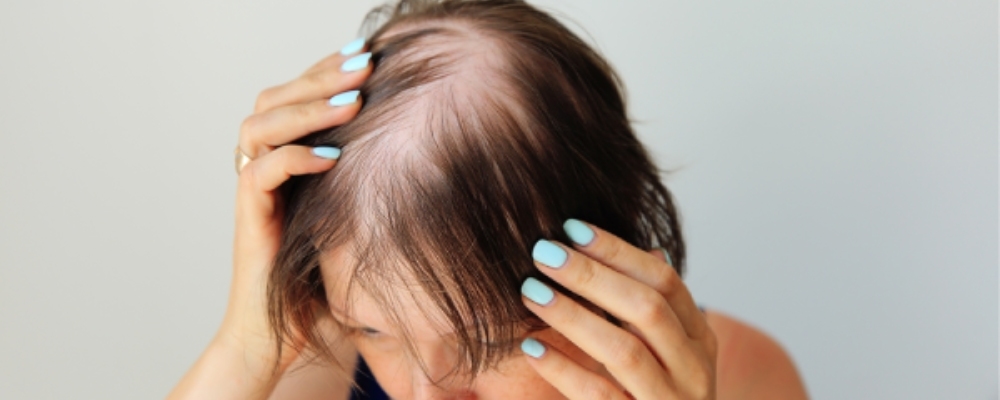 woman-suffering-from-alopecia-areata