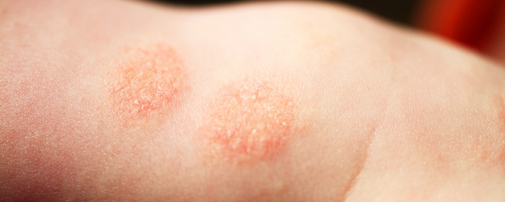 child-arm-affected-psoriasis