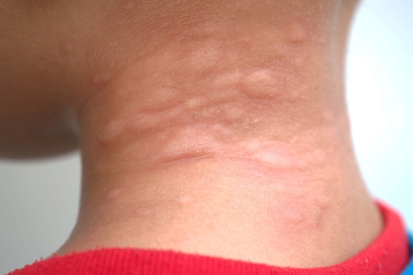 psoriasis-on-kids-neck