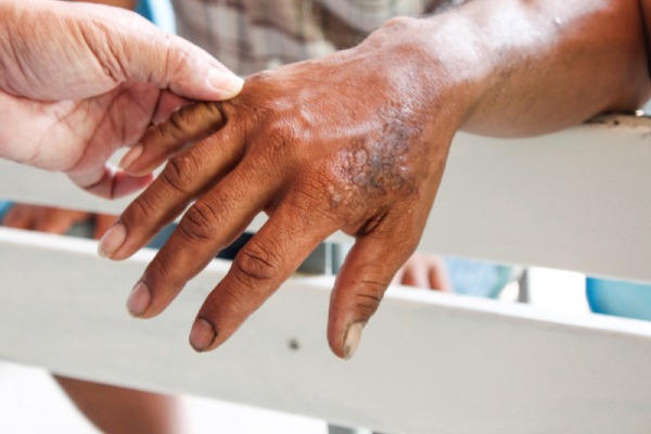 skin-infected-from-dermatits-neglecta