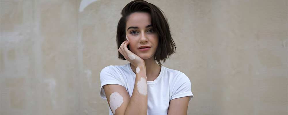 woman-with-segmental-vitiligo-on-hand