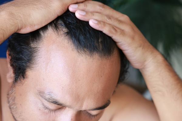 scarring-alopecia-symptoms