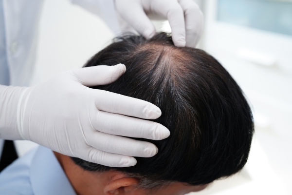 scarring-alopecia-treatment
