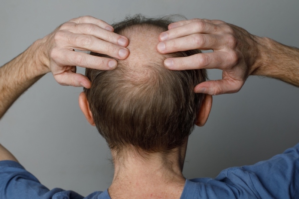 scarring-alopecia