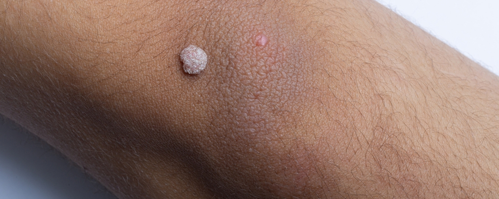 Common Warts