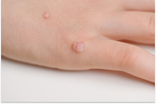 Common Warts