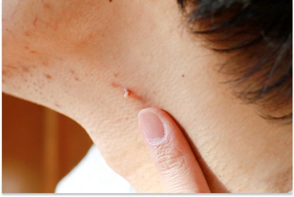 Filiform Warts