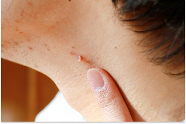 Filiform Warts