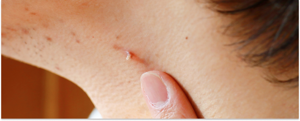 Filiform Wart