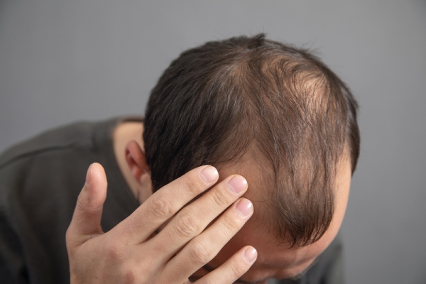 man-suffering-from-alopecia